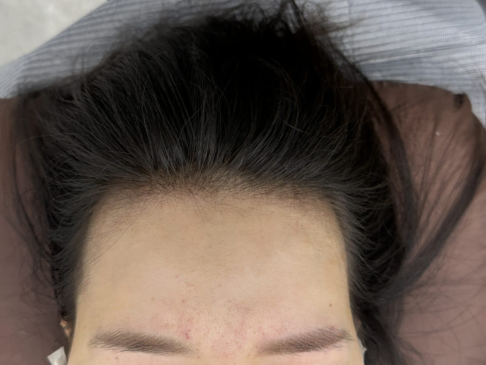 Hairline density result