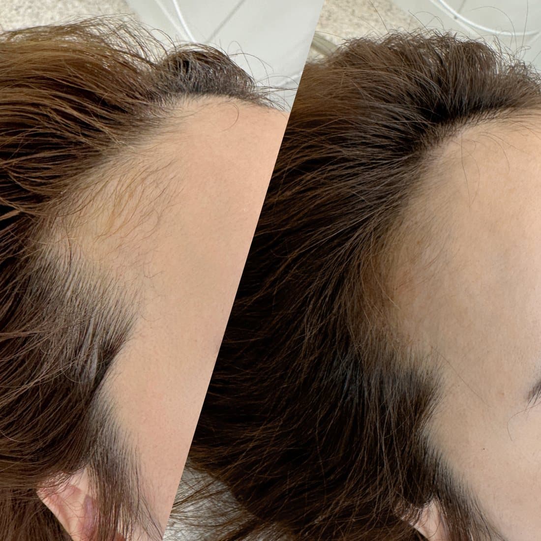 Hairline micropigmentation