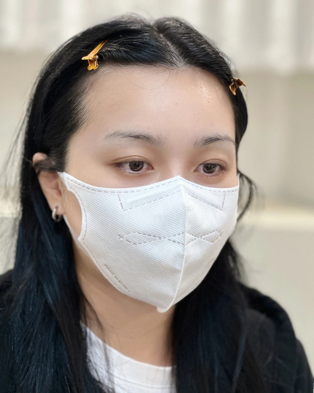 클래식 (기본 라인) · 사례 1 · 시술 전