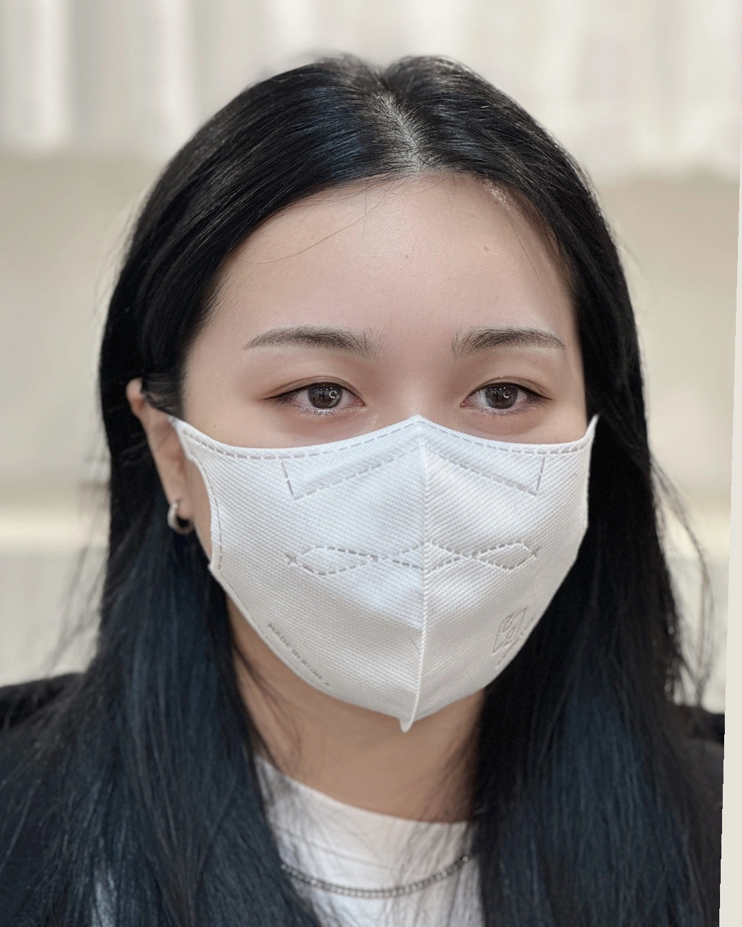 클래식 (기본 라인) · 사례 1 · 시술 후