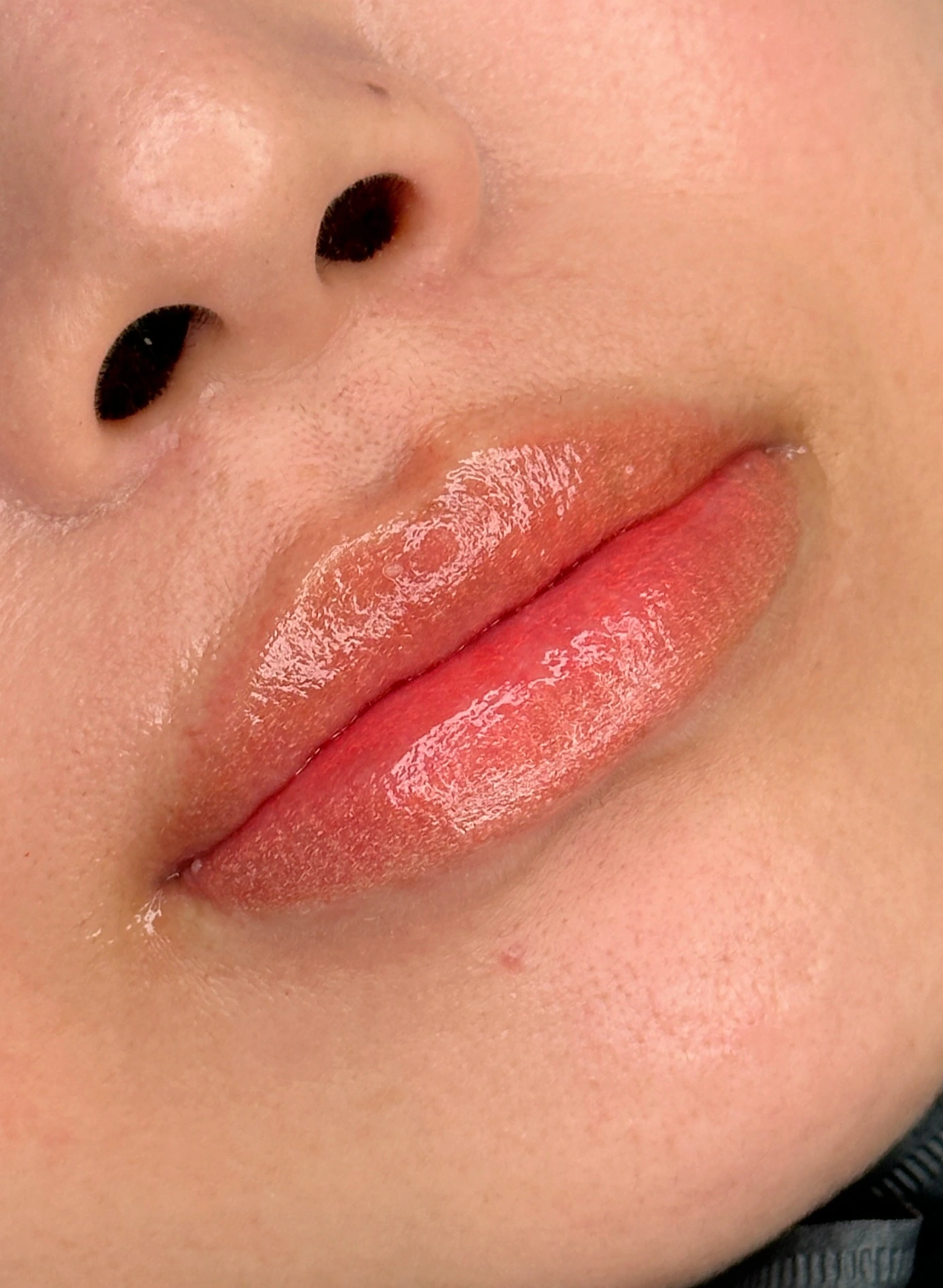 입술 모양 교정 + 중화
Lip Correction & Neutralization · 사례 1 · 시술 후