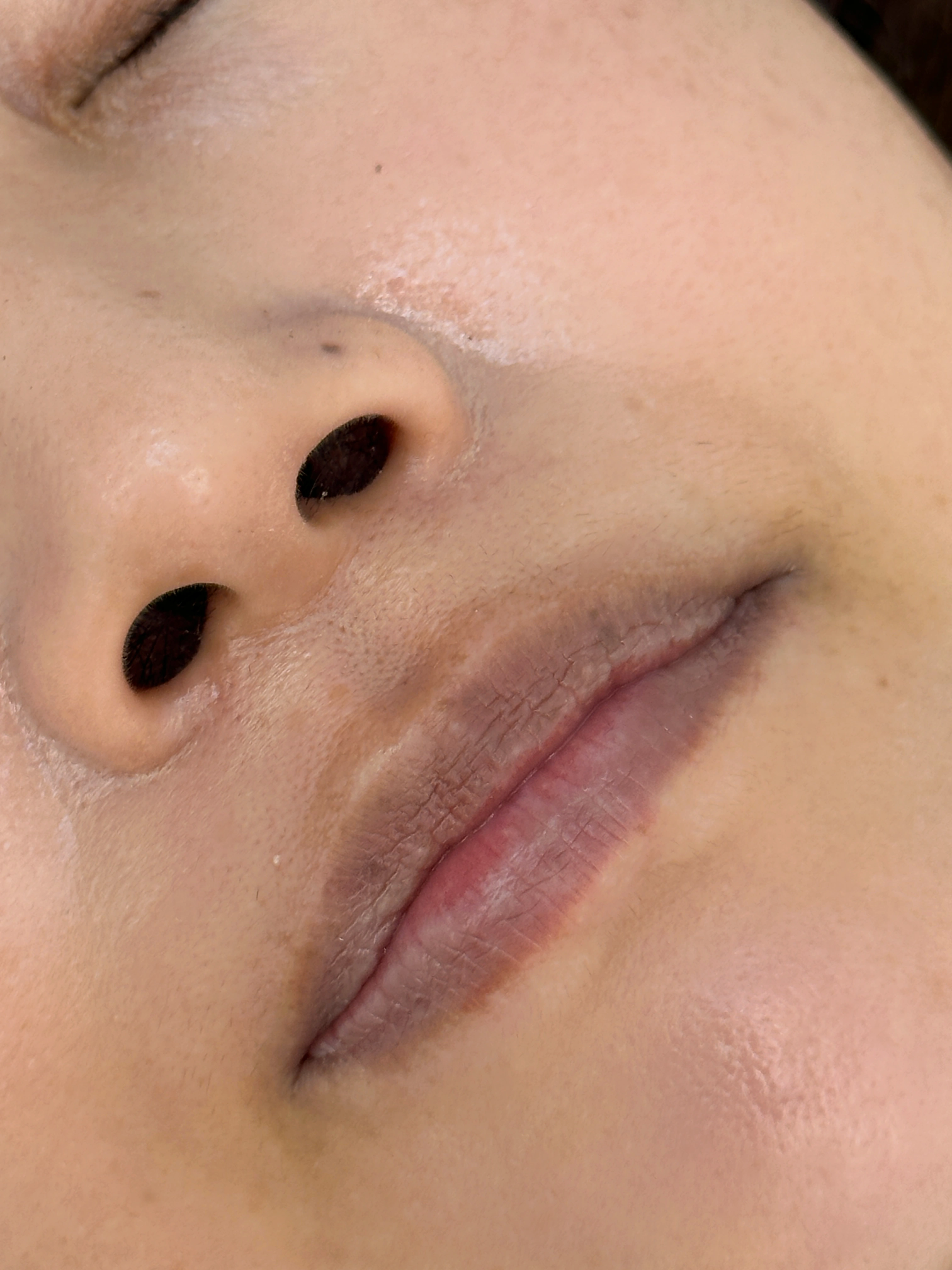 입술 모양 교정 + 중화
Lip Correction & Neutralization · 사례 1 · 시술 전