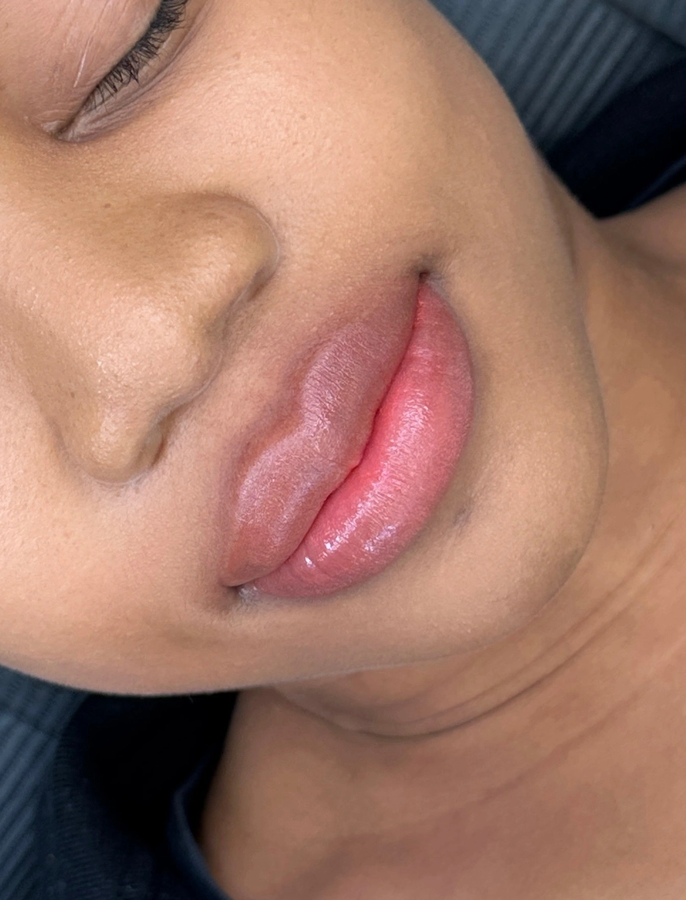 어두운 입술 중화 커버
Lip Neutralization · 사례 1 · 시술 후