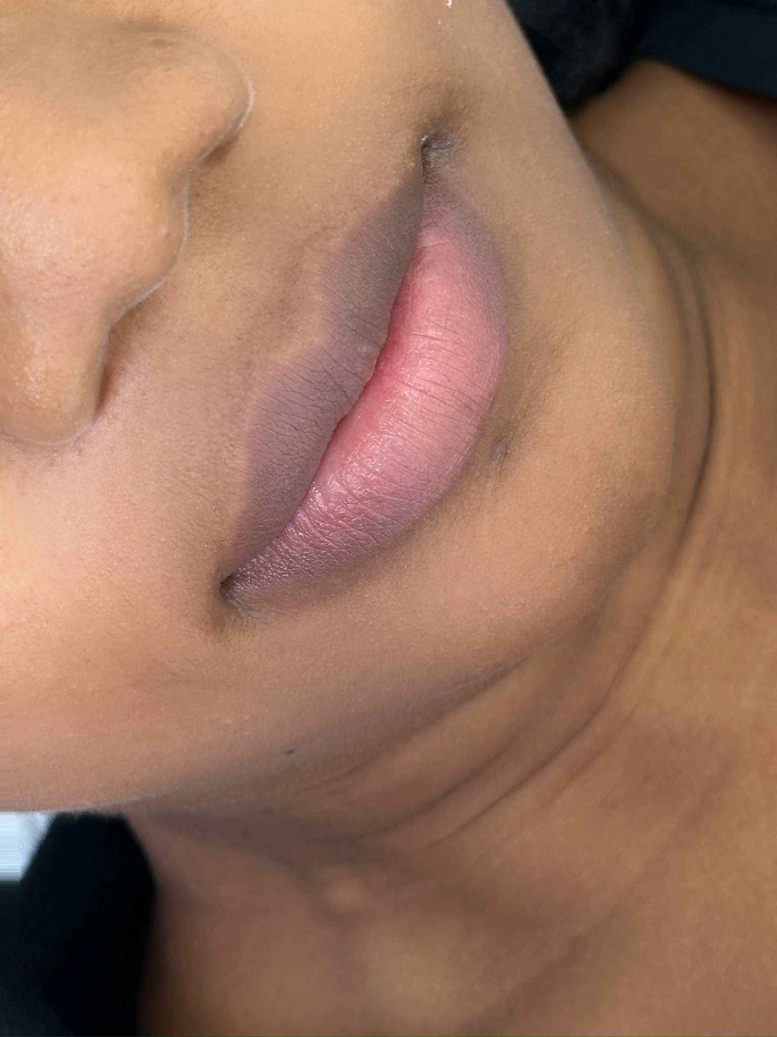 어두운 입술 중화 커버
Lip Neutralization · 사례 1 · 시술 전