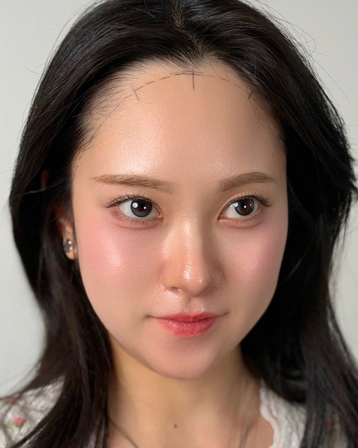 둥근 라인 · 사례 1 · 시술 전