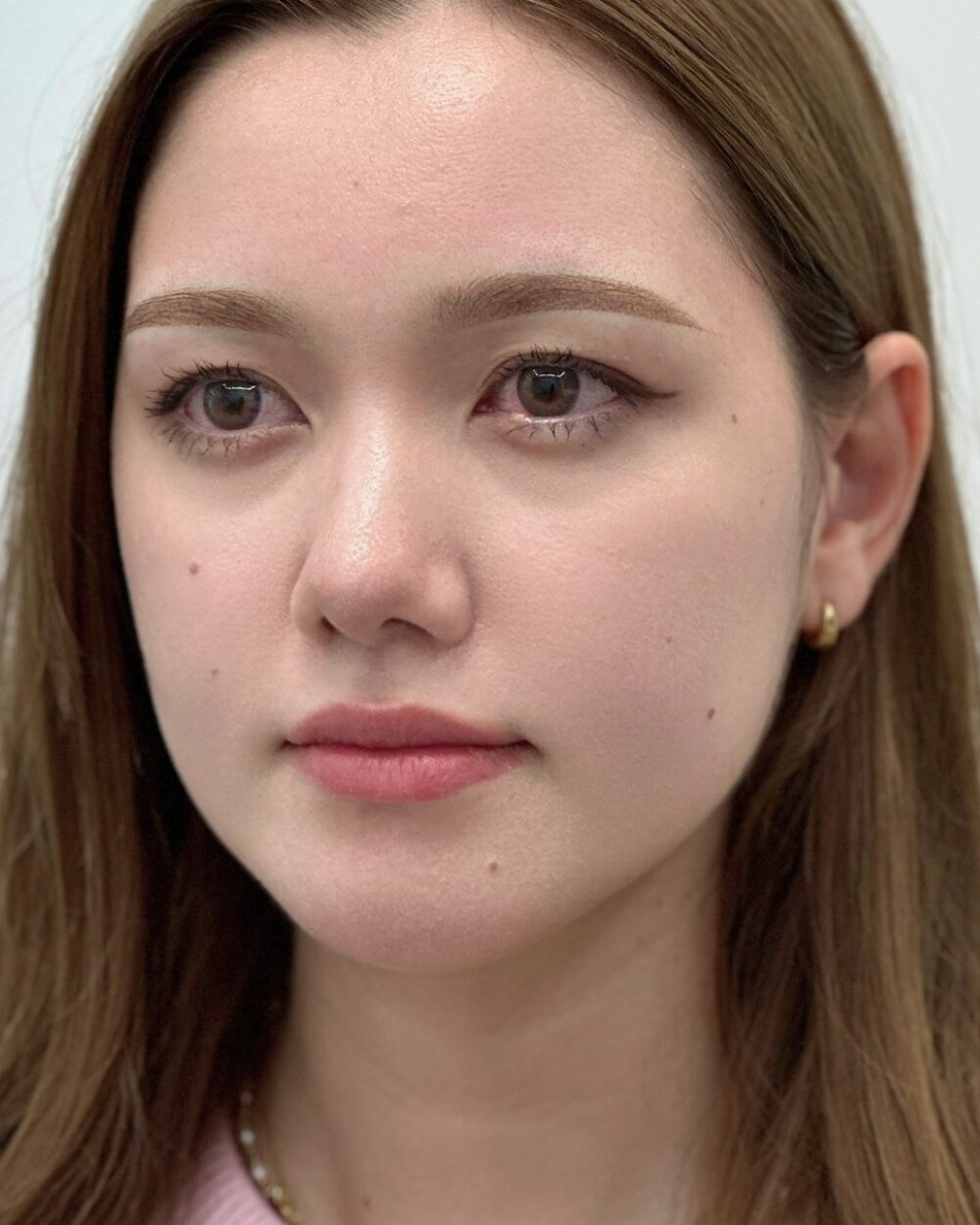 시술 결과 6